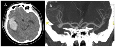 Case series: Intraoperative neuromonitoring and angiography in the surgical treatment of vascular malformations